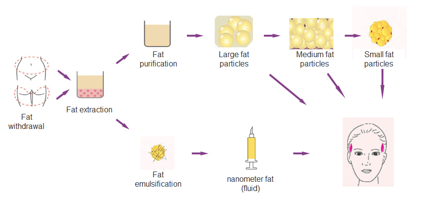 temple fat filling process