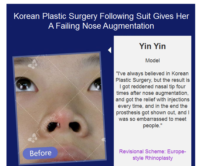 nose job revision