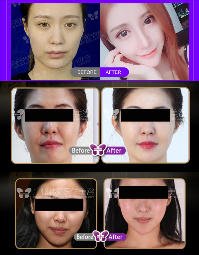 facial contouring