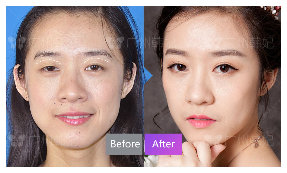 cosmetic surgeries or non-invasive treatments photos