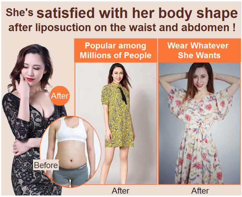 hanfei liposuction in china, face,neck,waist,abdomen,back,arms, legs cost 5000-20000rmb