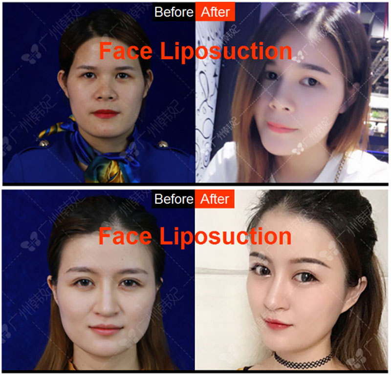 hanfei liposuction in china, face,neck,waist,abdomen,back,arms, legs cost 5000-20000rmb