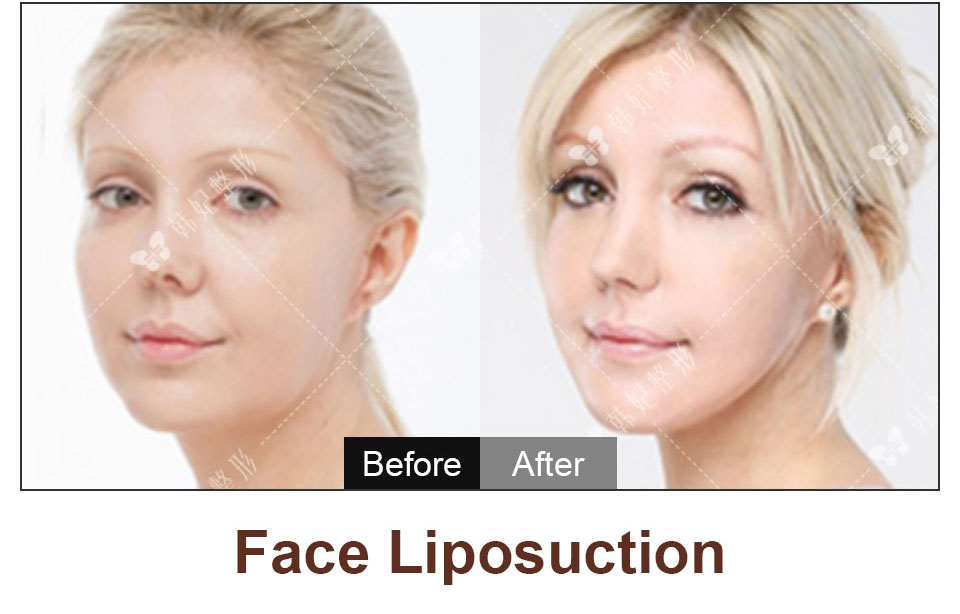 face liposuction